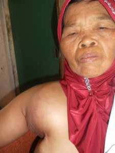 Ny. Oneng (57) penderita kangker payu dara Warga kampung Bojongloa, Kecamatan Bayongbon Garut, foto Kus 